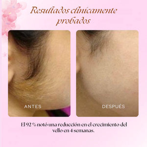 ✨ Aceite de Cyperus Rotundus  para la reducción permanente y natural del vello